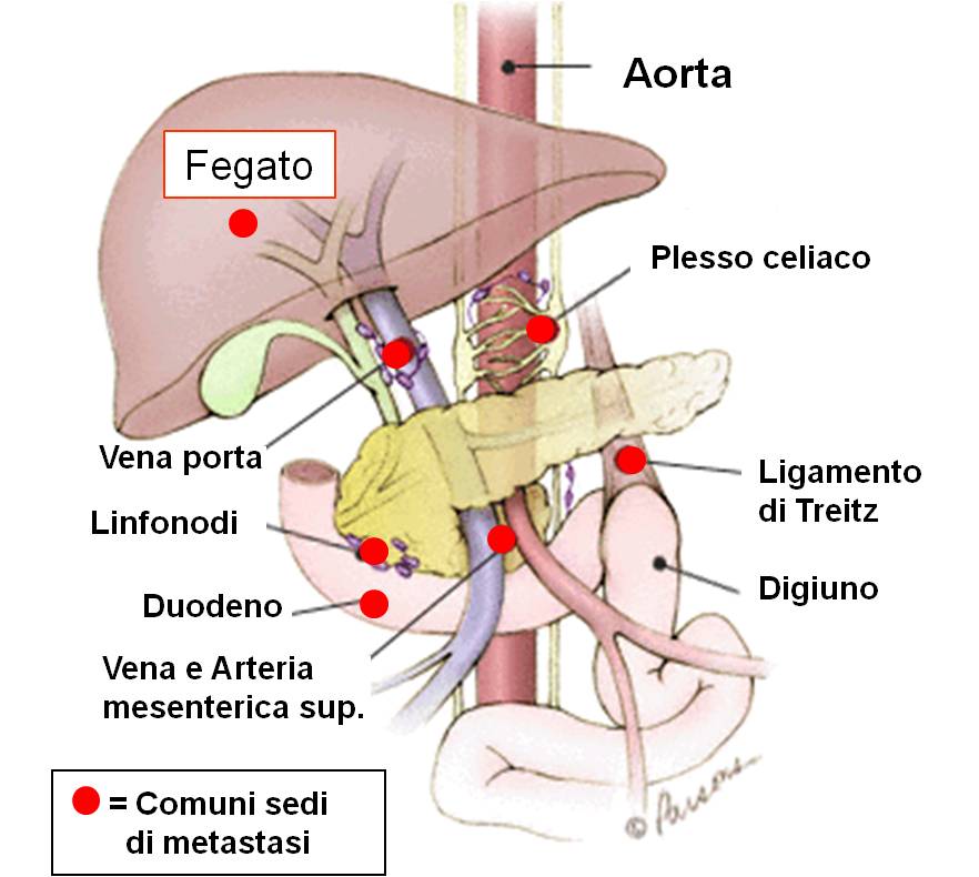 BB Sedi comuni di metastasi