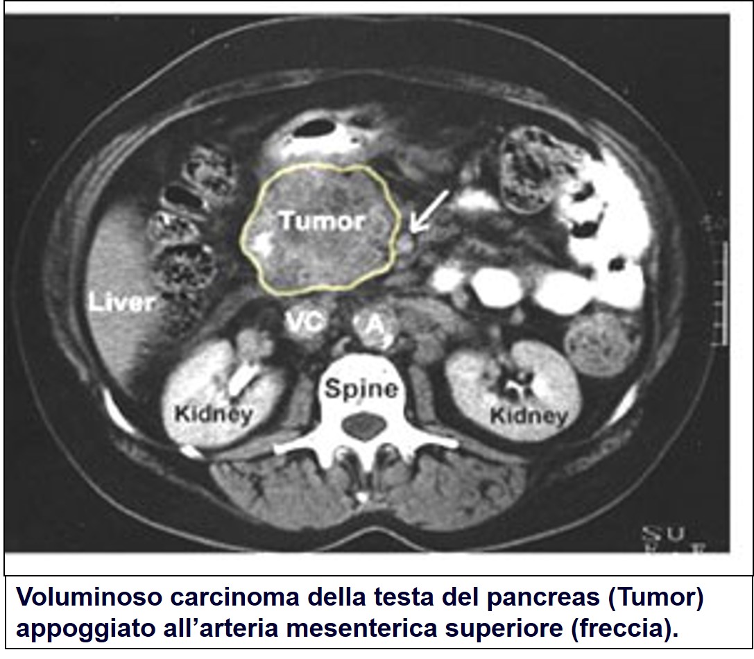 TAC di carcinoma pancreatico