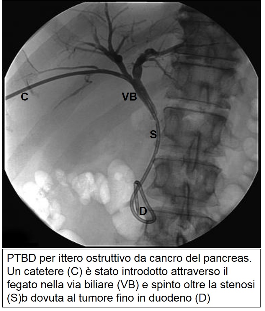 PTBD di carcinoma pancreatico