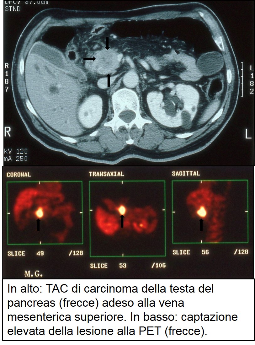 TAC e PET di carcinoma cefalo pancreatico 
