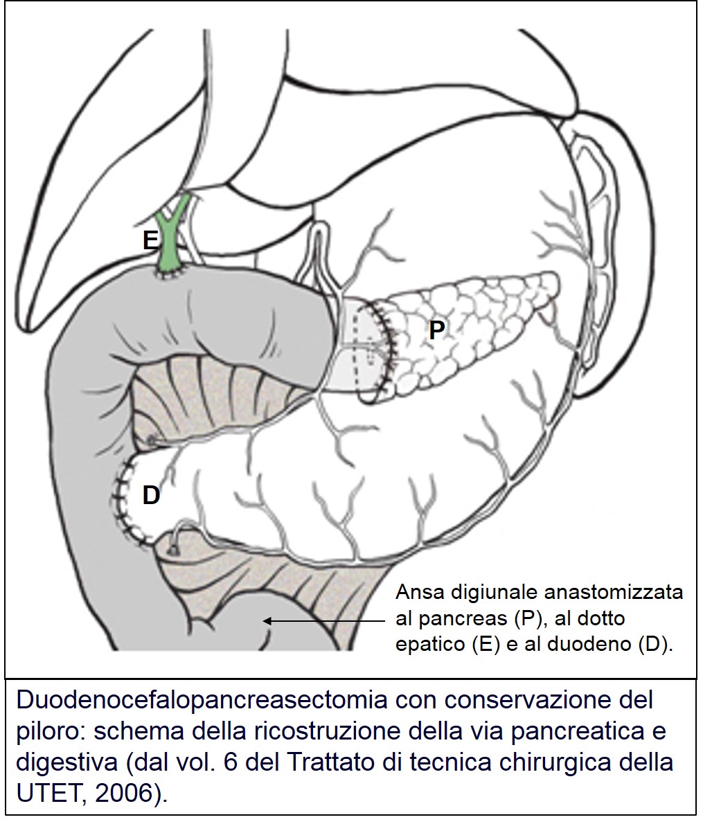 Ricostruzione dopo DCP