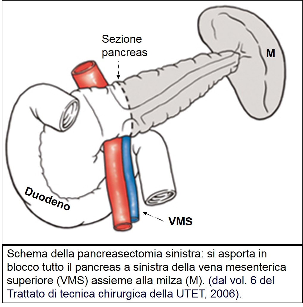 Pancreasectomia sinistra