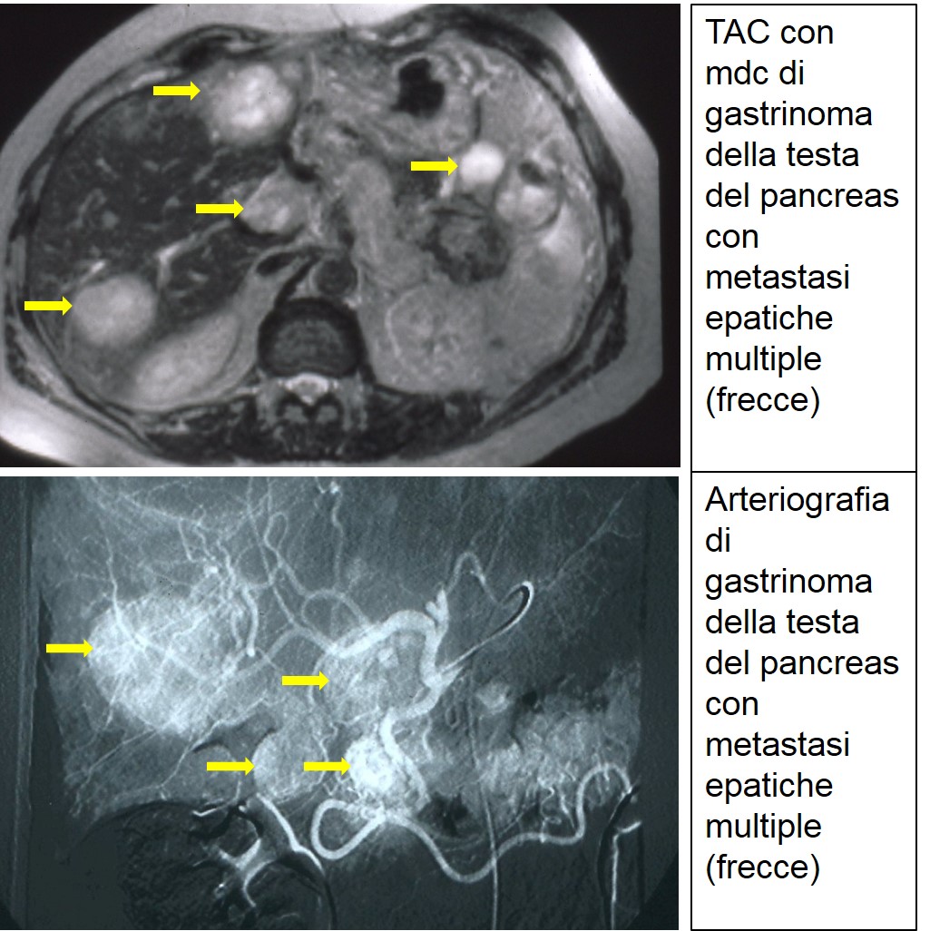 TAC e arteriografia di gastrinoma metastatico 