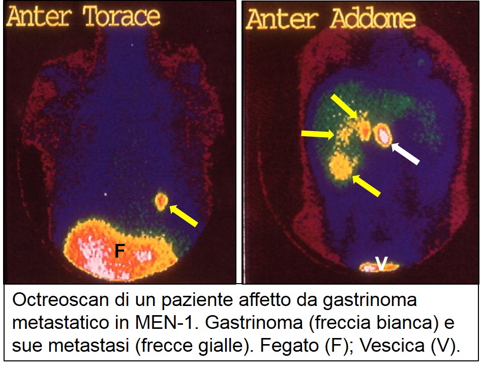 Octreoscan di gastrinoma metastatico