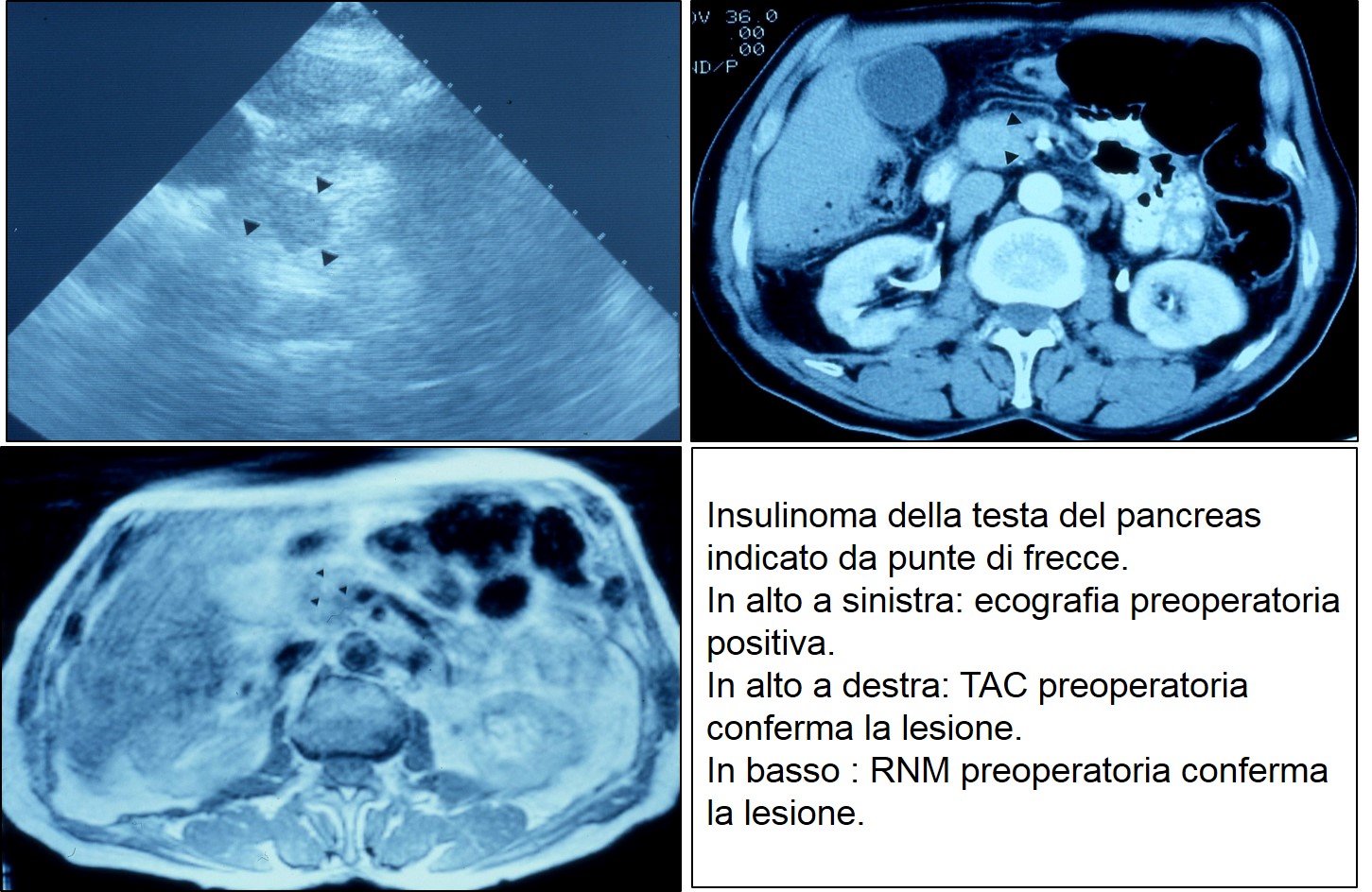 Eco TAC RNM di insulinoma cefalico