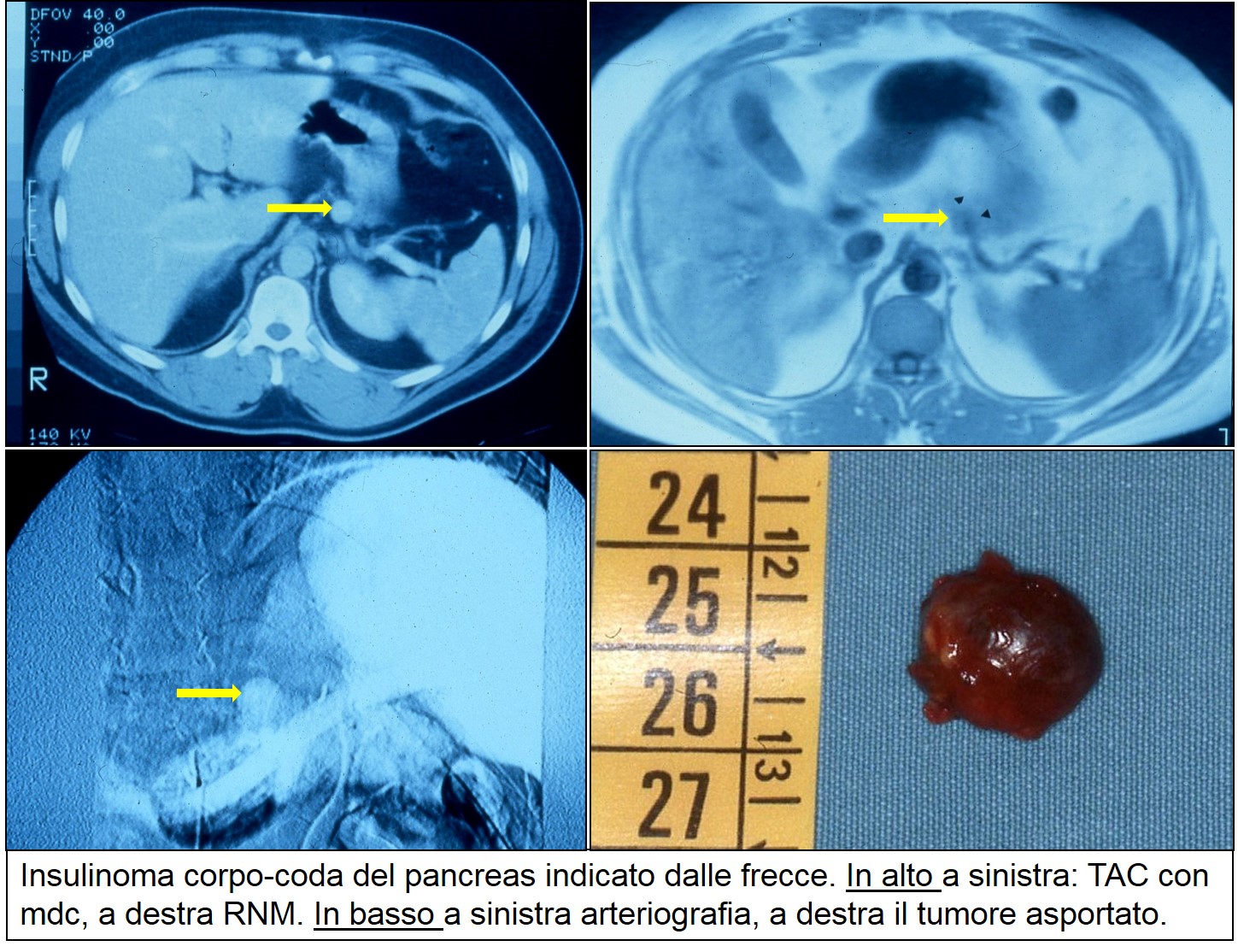 TAC RNM e arteriografia di insulinoma