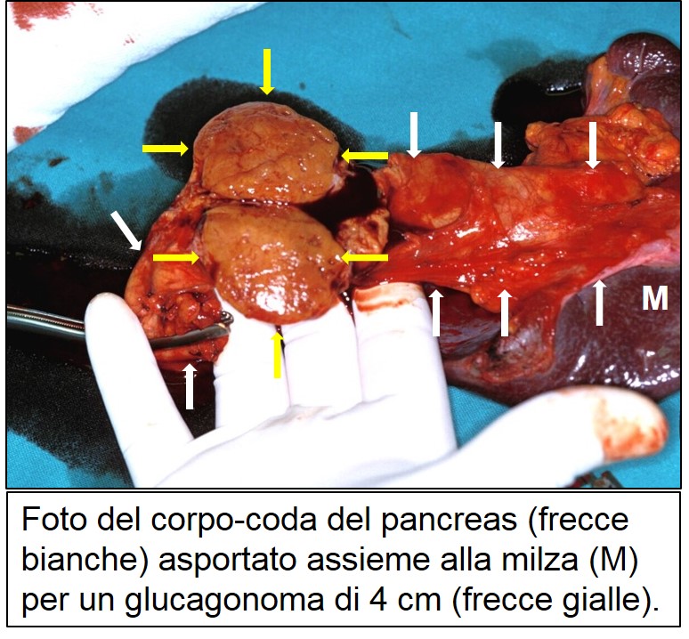 foto pezzo opera di glucagonoma 4 cm