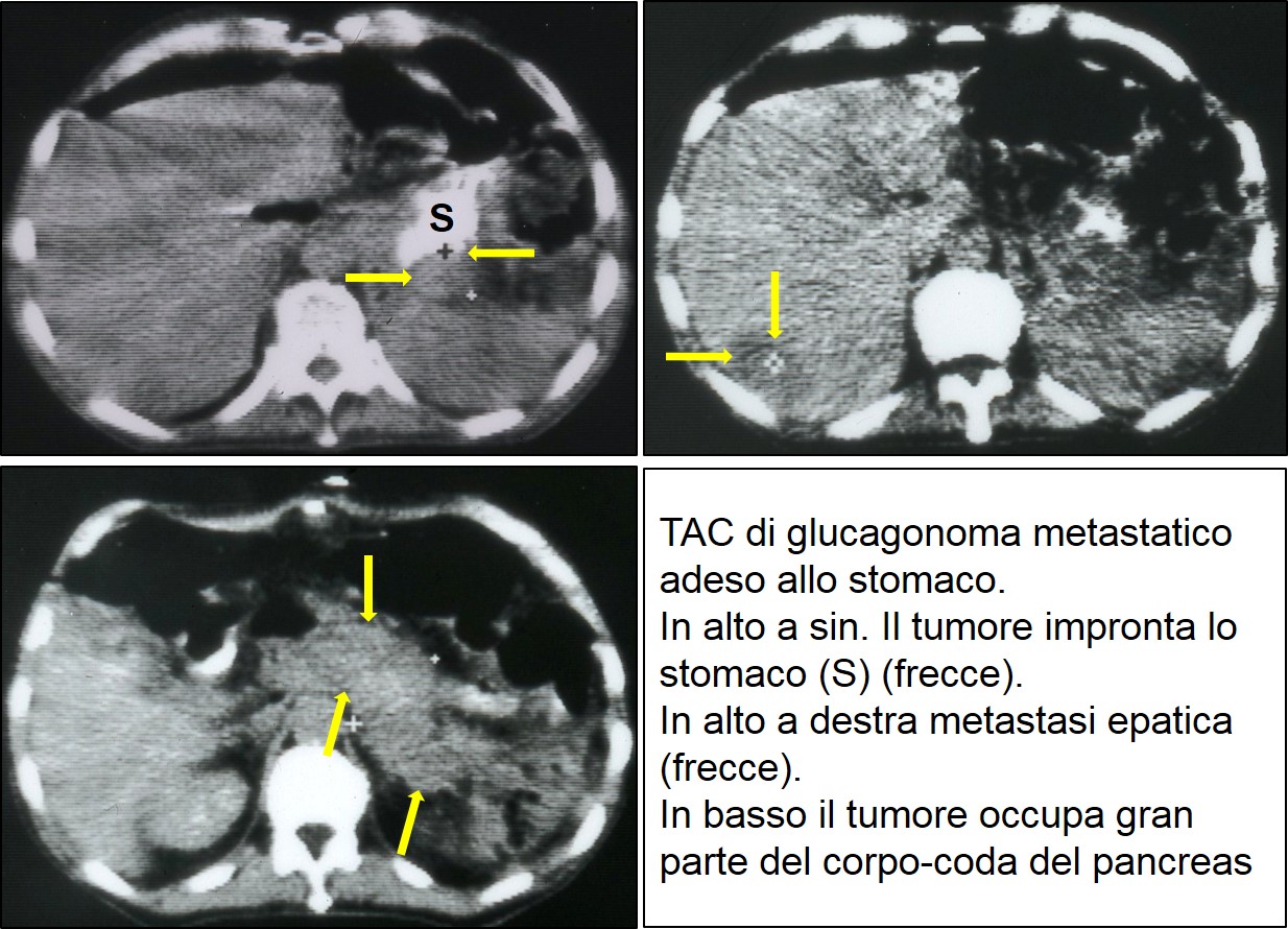 TAC di glucagonoma metastatico 