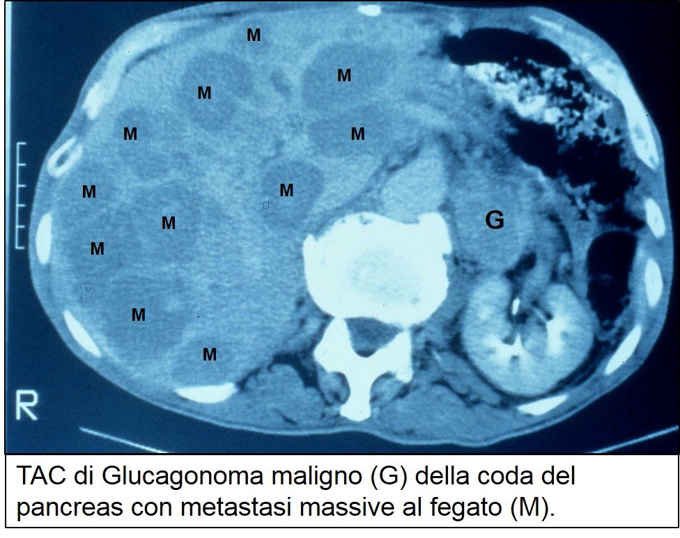 TAC di glucagonoma con metastasi massive
