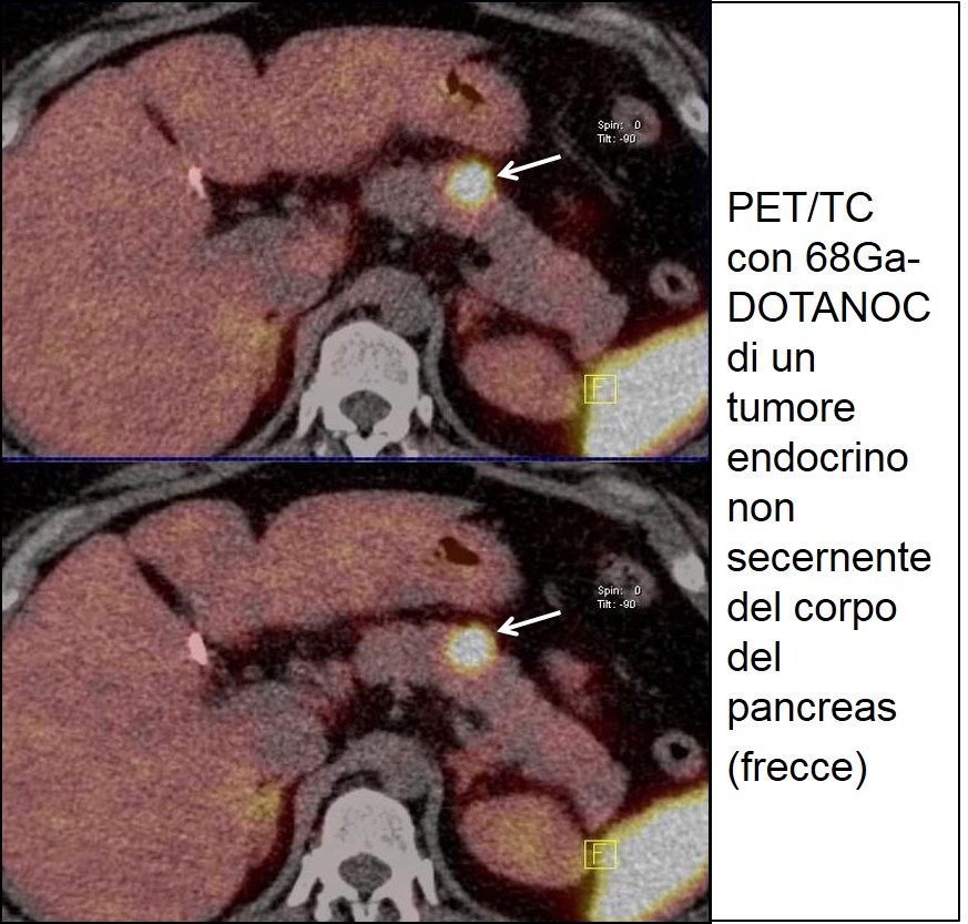 68Ga-DOTANOC di TEP non funzionante