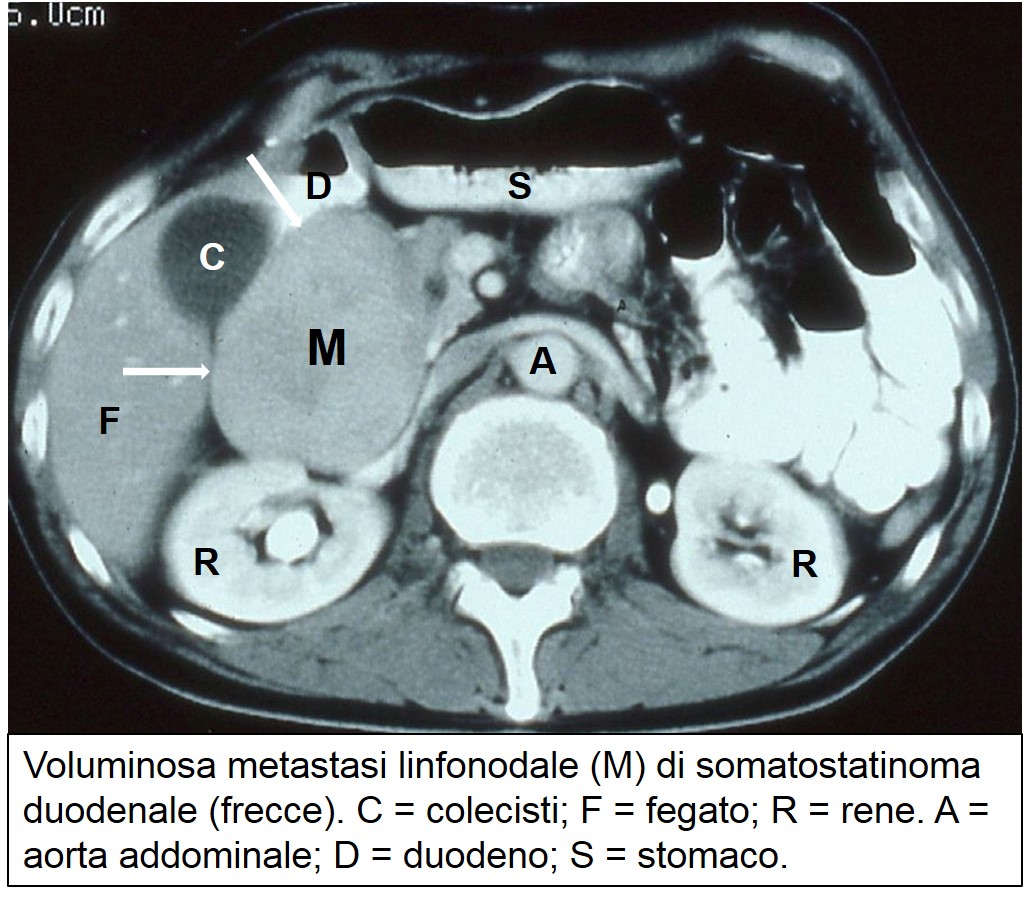 meta linfonodale di somatostatinoma