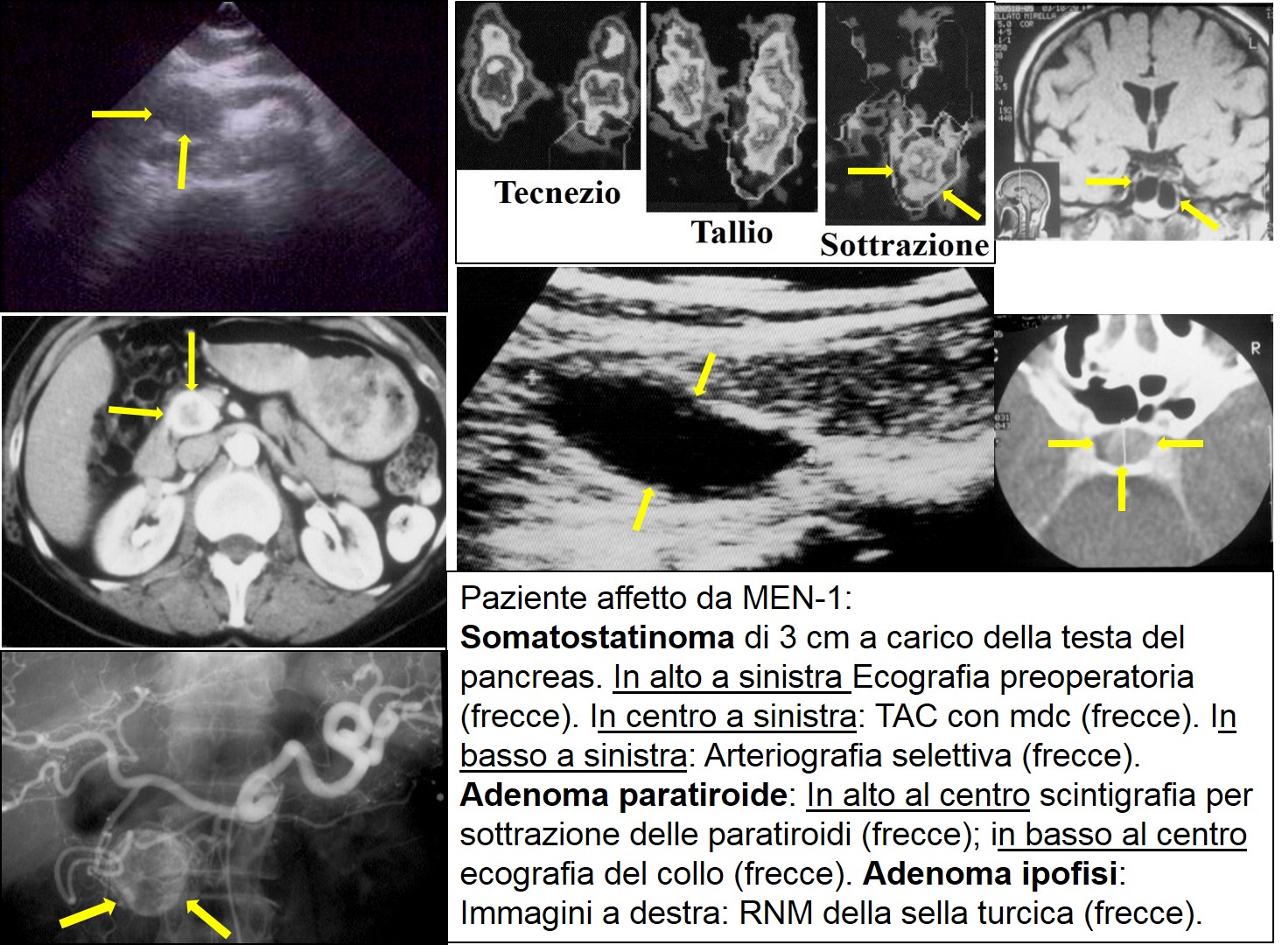 MEN-1 Pancreas Paratiroide Ipofisi 