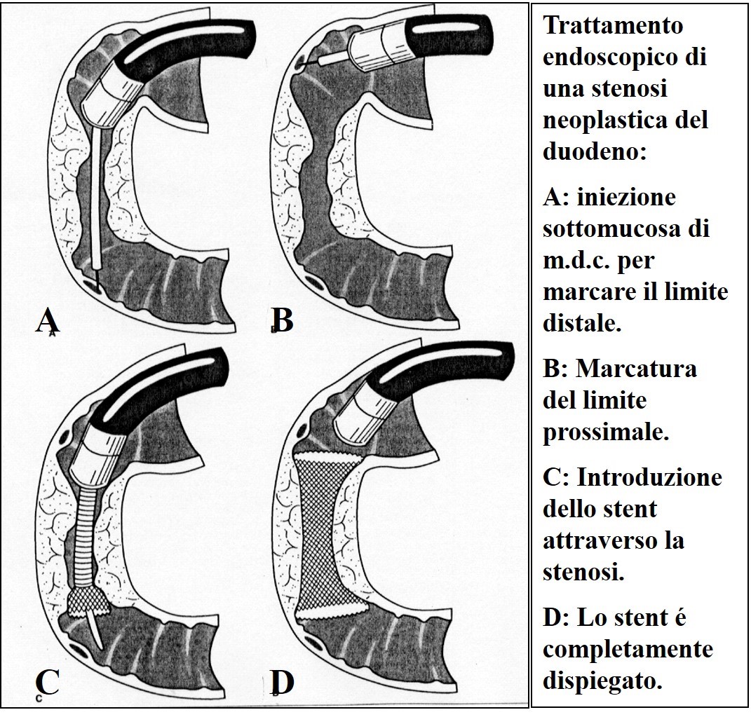 Posizionamento di endoprotesi per stenosi duodenale