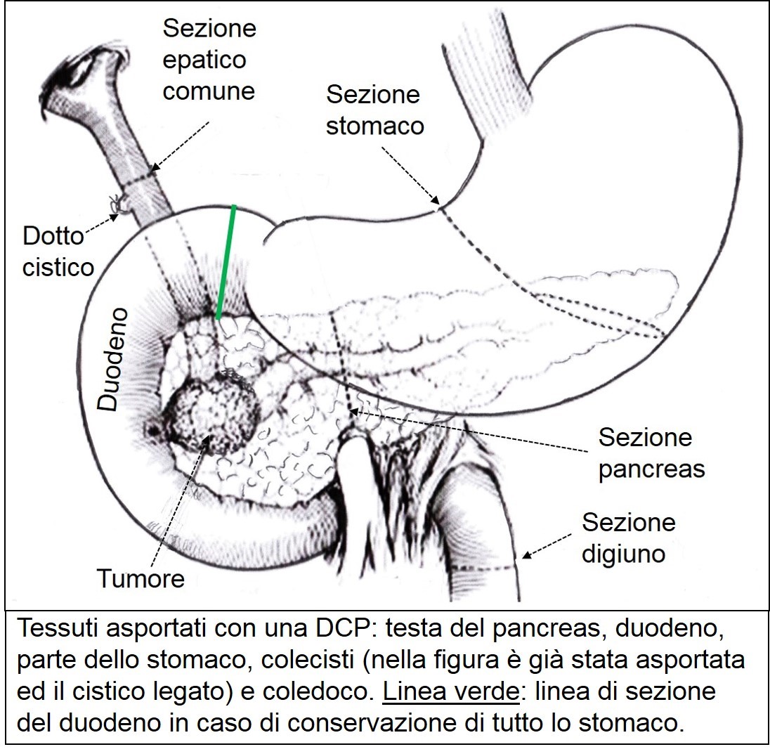 Tessuti asportanti mediante DCP