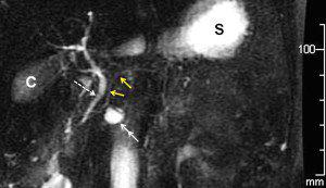 Wirsung RMN  in paziente con IPMN 