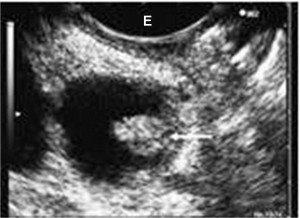 Ecoendoscopia di un IPMN 