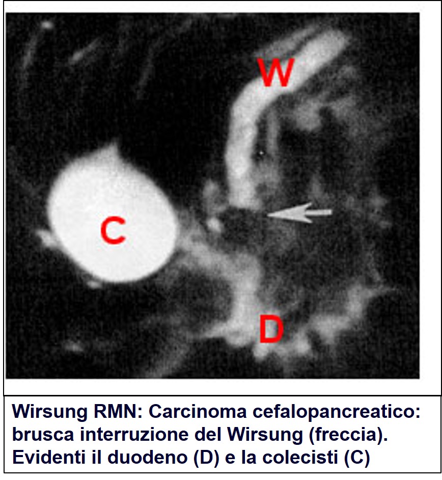Wirsung RMN di carcinoma pancreatico