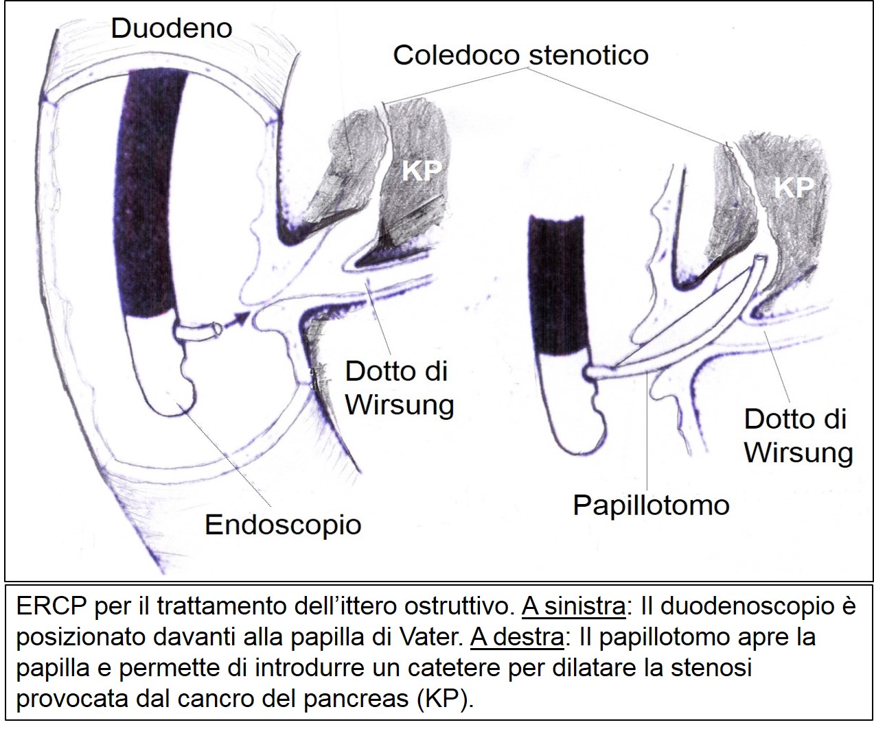 ERCP per ittero ostruttivo