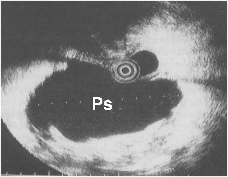 Ecoendoscopia