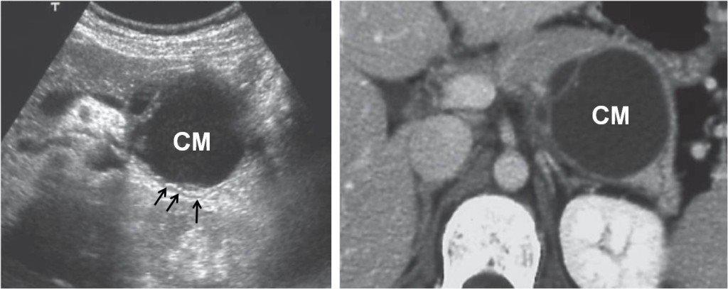 Il cistoadenoma pancreatico 