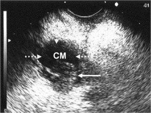 Ecoendoscopia