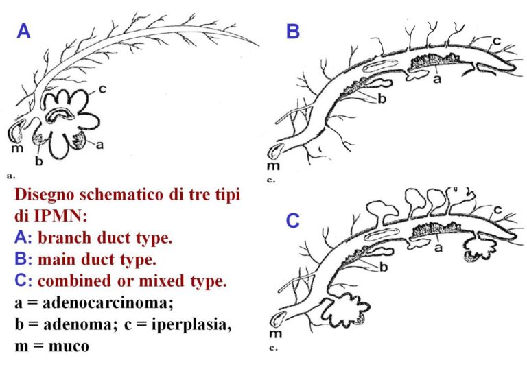 tre tipi di IPMN