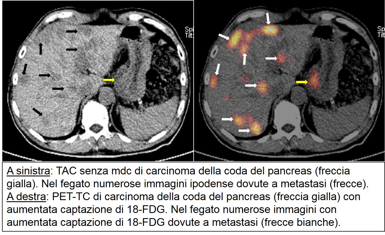  PET-TC di carcinoma cefalopancreatico