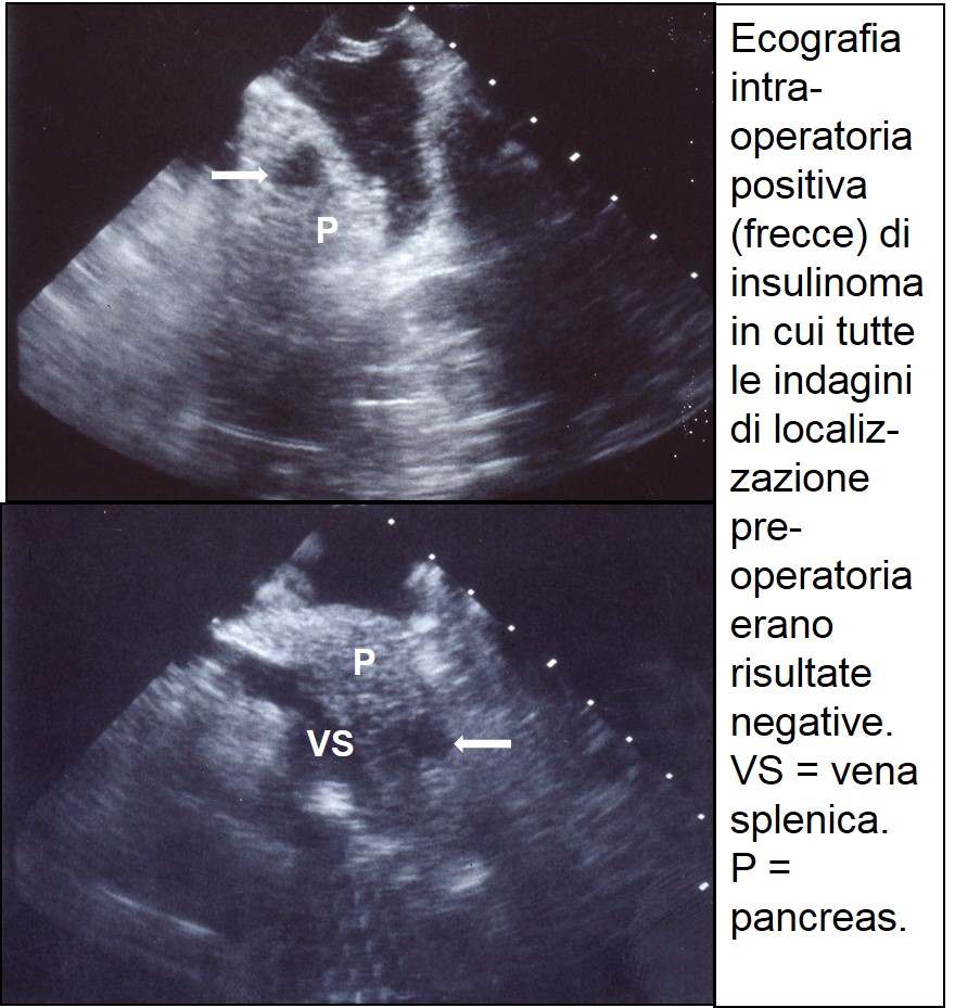 cografia intraoperatoria di insulinoma