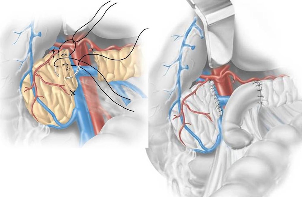 Pancreasectomia intermedia - schema