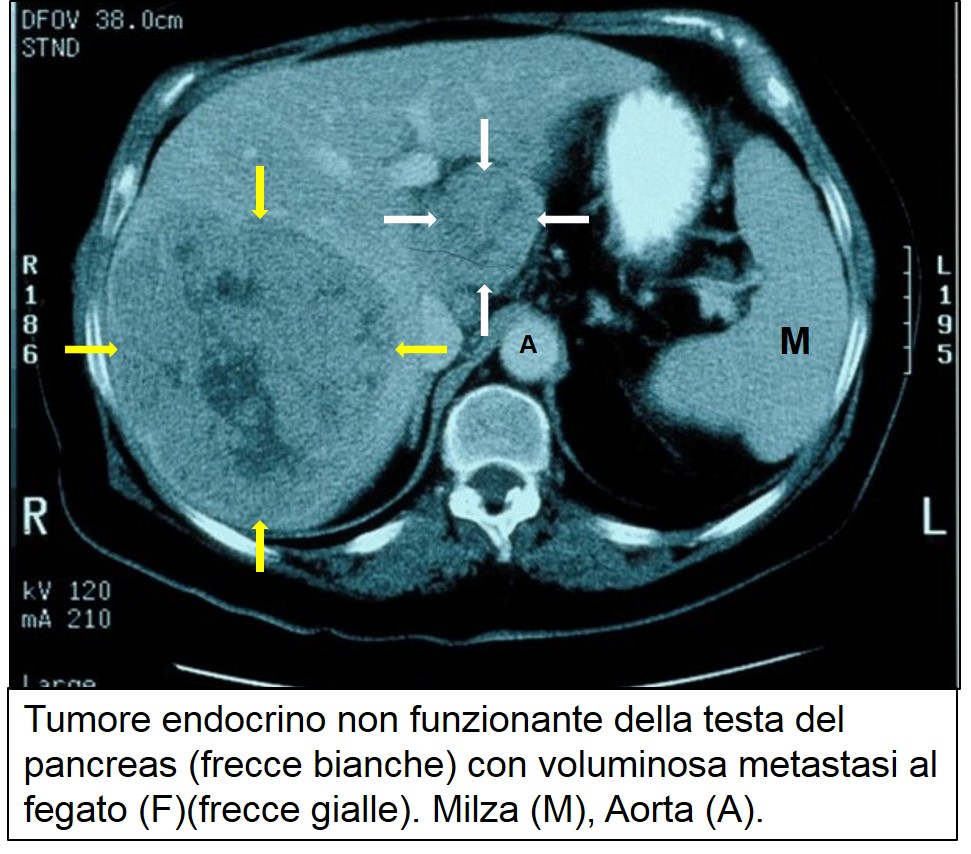 TAC di TEP non funzionante metastatico