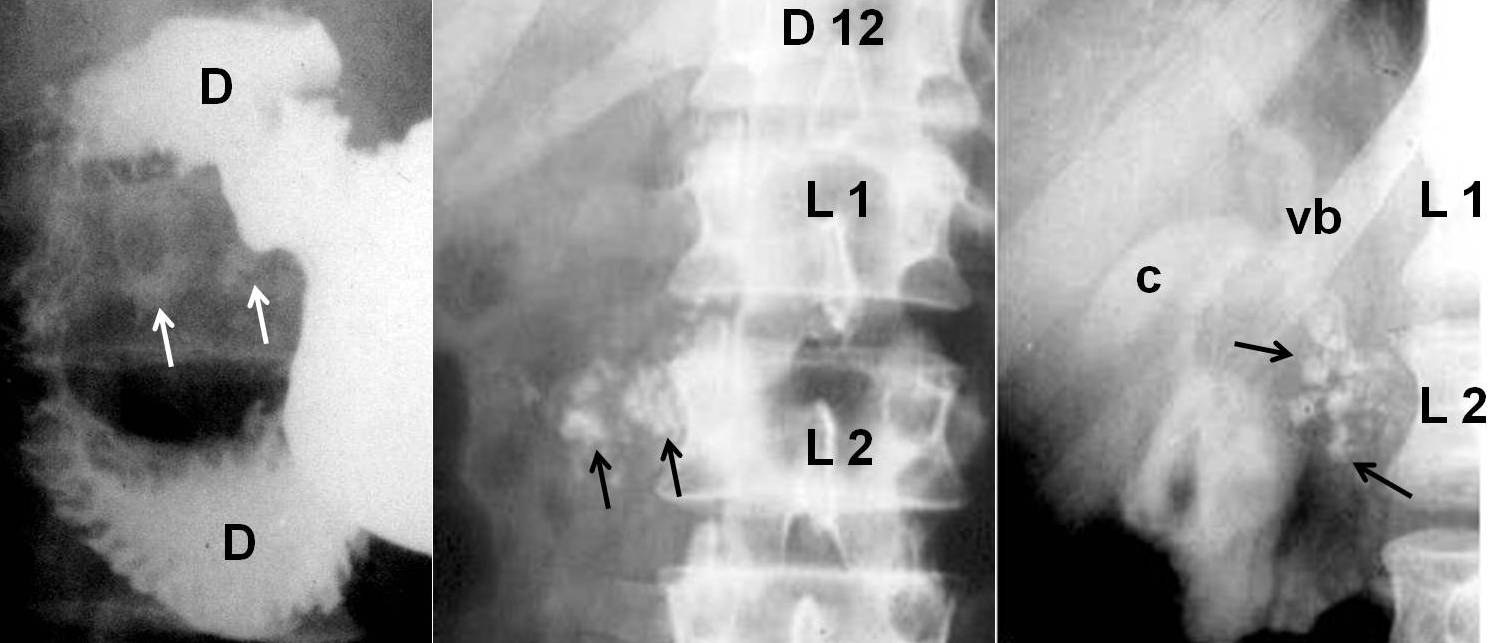 Pancreatite Cronica calcificazioni 4 