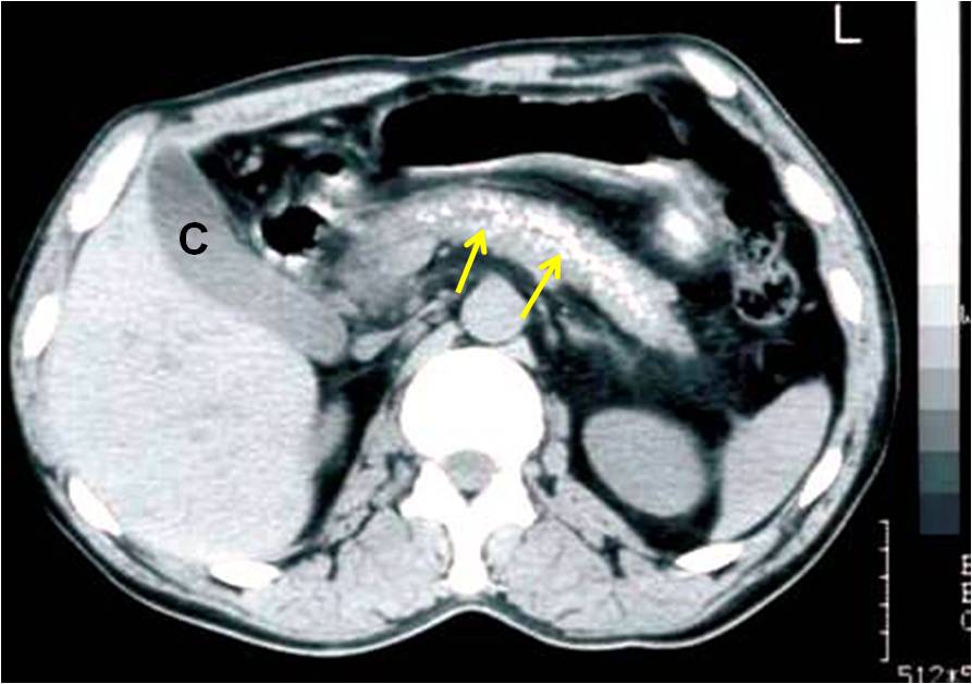 TAC Pancreatite Cronica calcificazioni