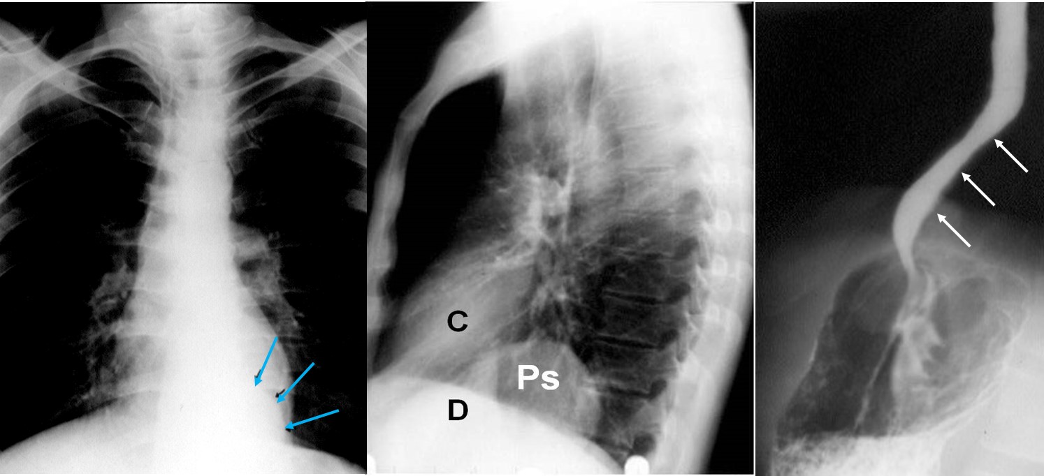 Rx torace pseudocisti in Pancr Cronica 