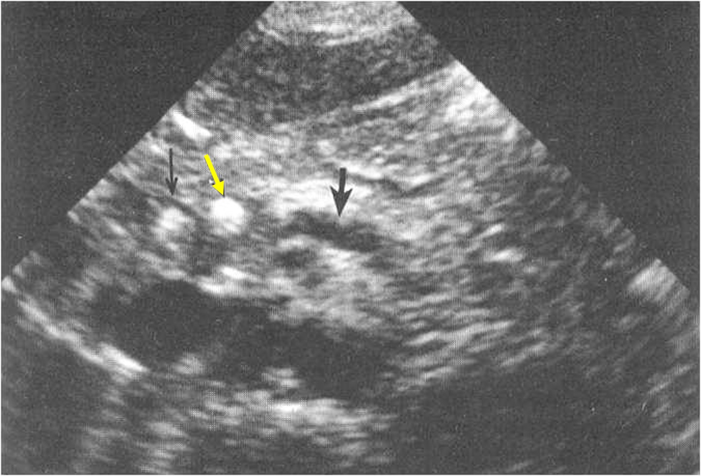 Ecografia di Pancreatite cronica con calcolo 