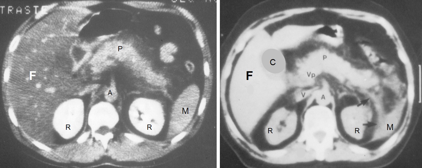 Pancreatite Acuta edematosa TAC