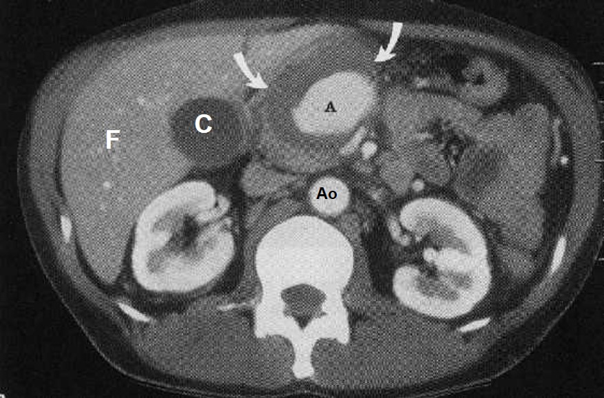 seudocisti post pancreatite acuta e pseudoaneurisma