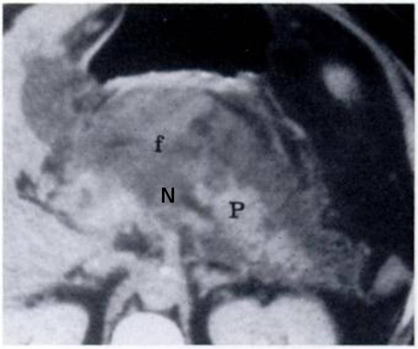 Pancr Acuta necrosi TAC